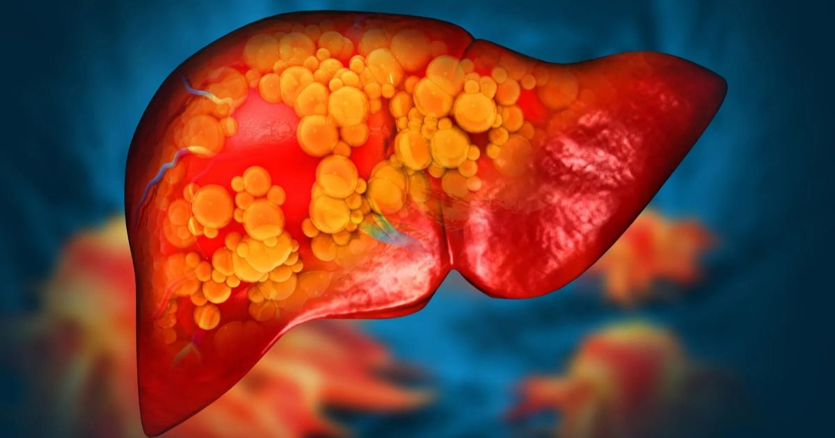 Polyethylene microplastics linked to fatty liver disease, especially ...
