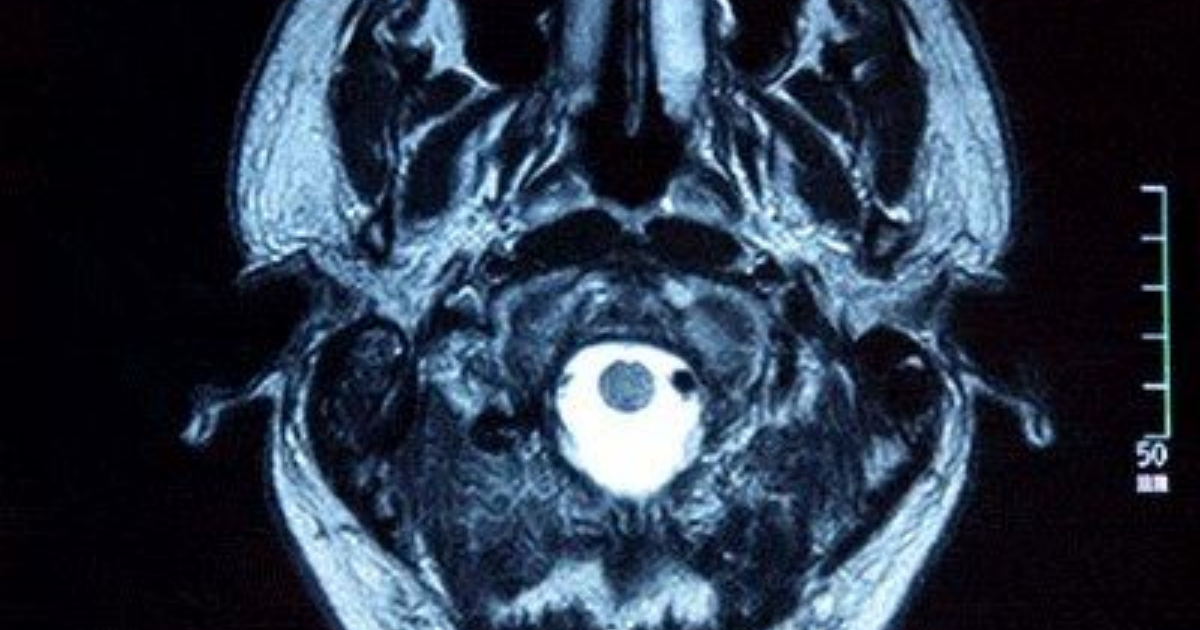 Ultrashort radio waves reportedly boost brain waste clearance in ...